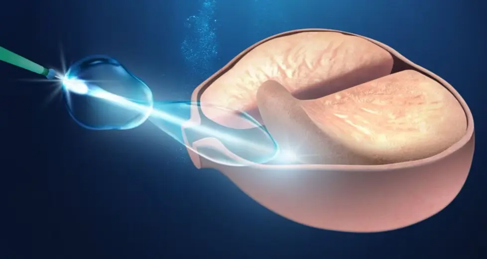 Próstata Aumentada: Quando é Hora de Fazer Cirurgia ou Mudar o Tratamento
