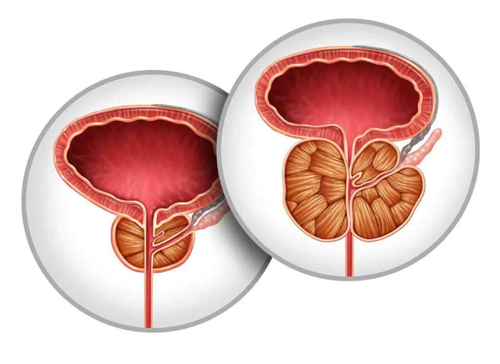 Próstata Aumentada: Quando é Hora de Fazer Cirurgia ou Mudar o Tratamento — imagem complementar