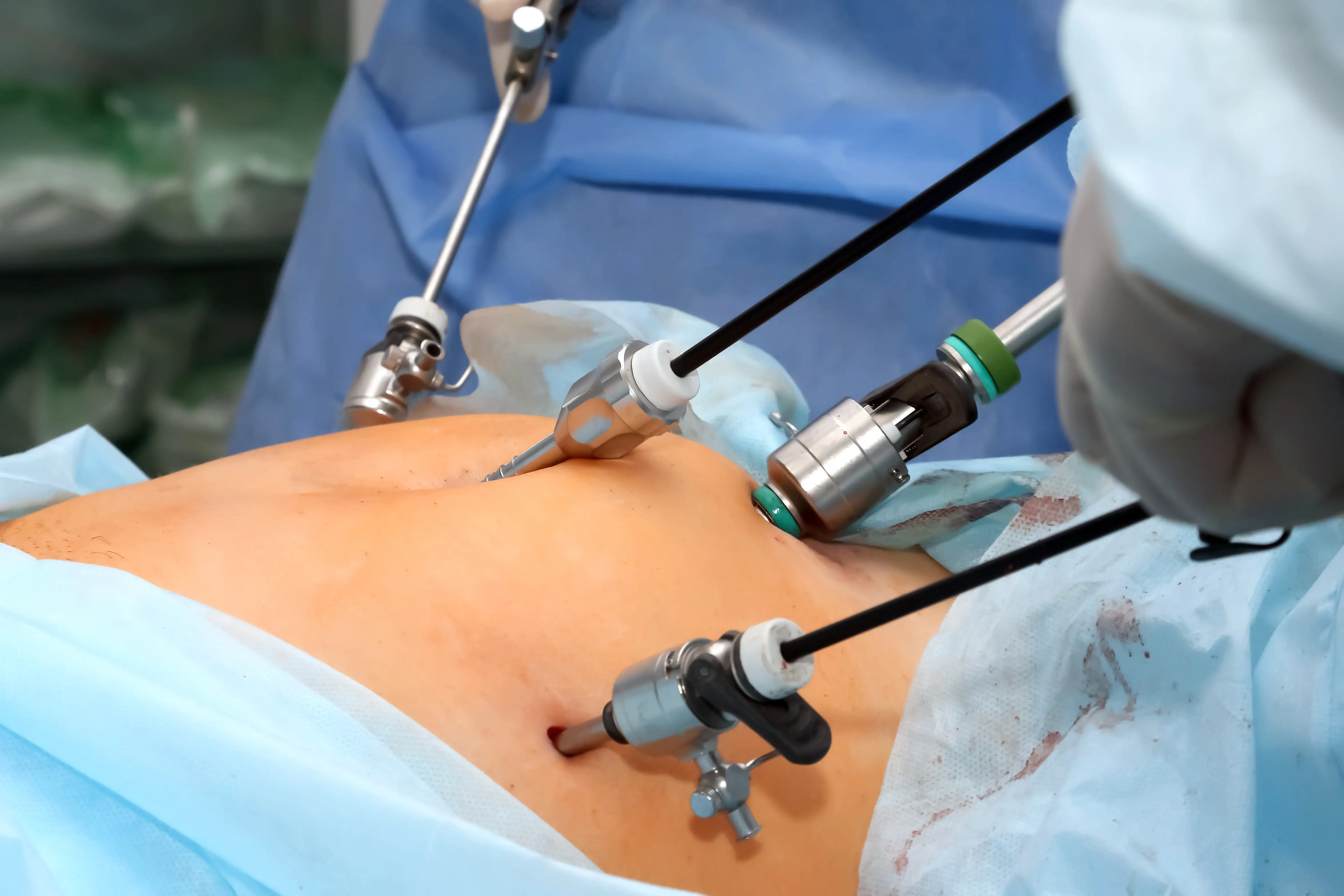 Cirurgia Robótica x Laparoscopia: quais as diferenças e vantagens para o paciente — imagem complementar
