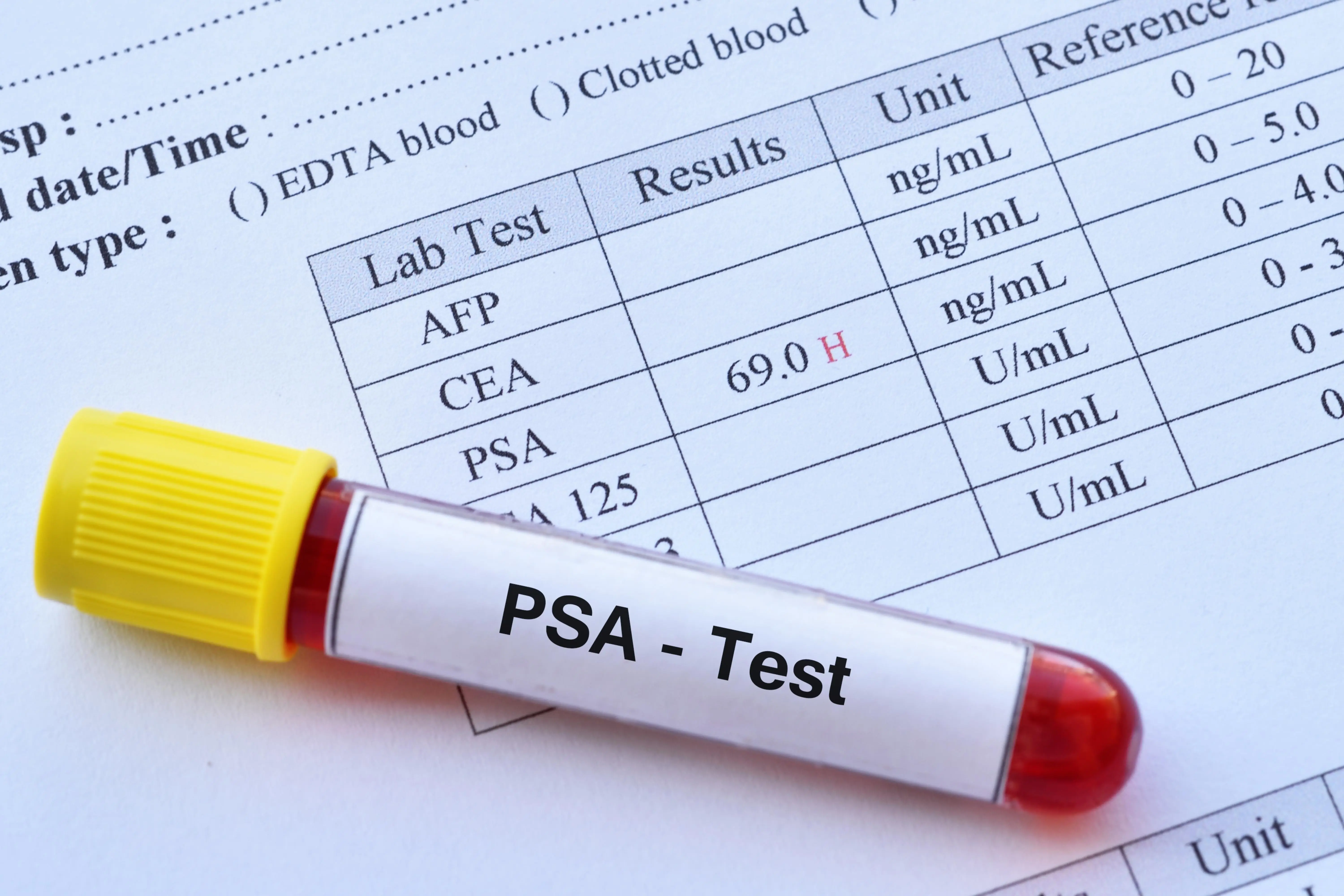 PSA alterado: o que significa e quais exames fazer a seguir