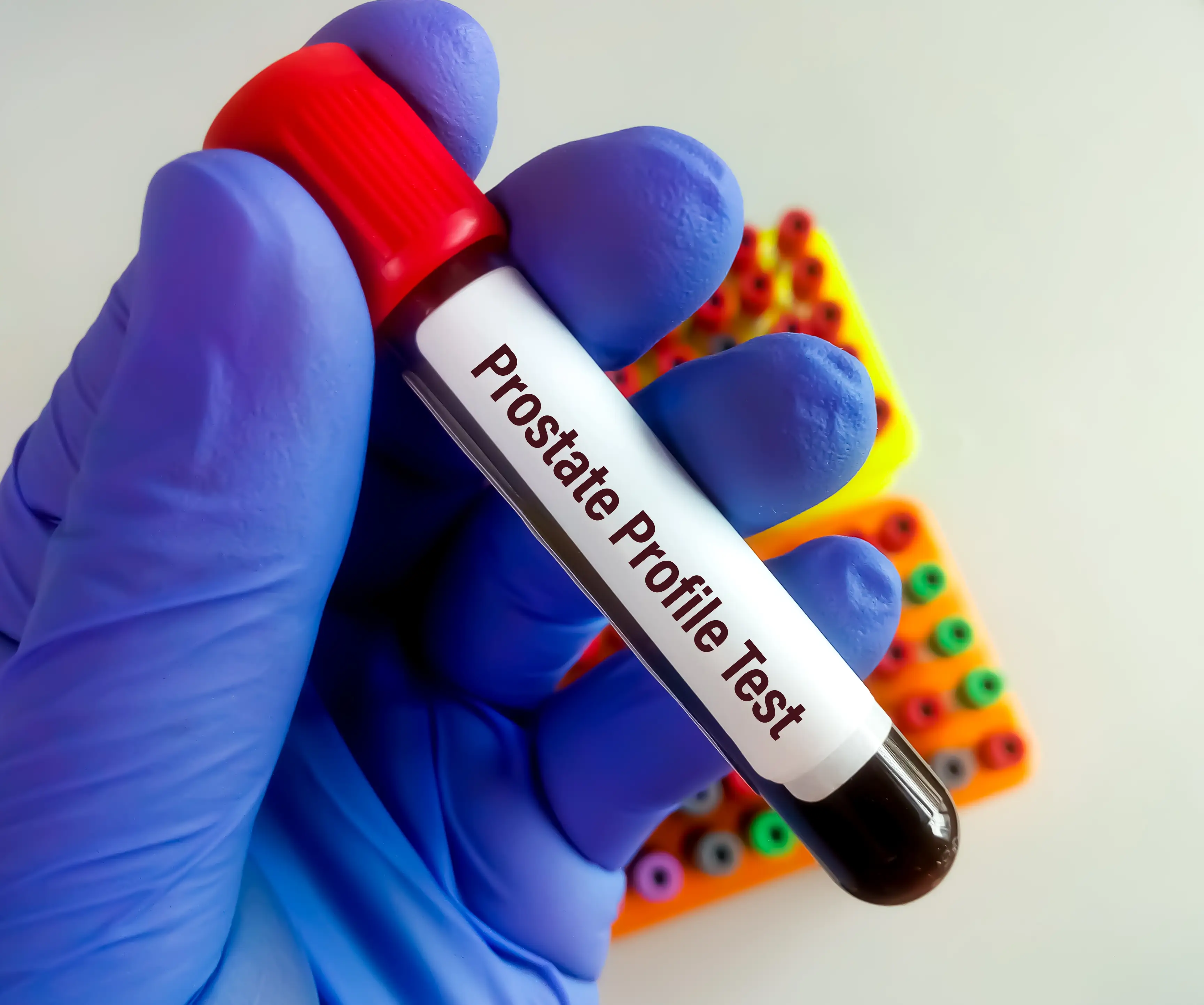 PSA alterado: o que significa e quais exames fazer a seguir — imagem complementar